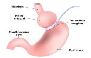 Virtuele maagband: een veilig alternatief voor chirurgische ingrepen